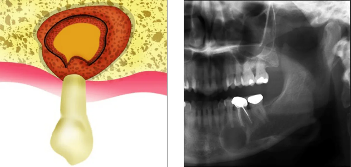 Surgical diagram of an apicoectomy showing root-end resection, retrograde canal preparation, and MTA retrofill seal