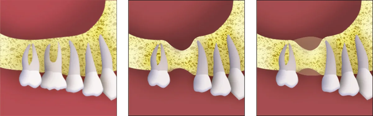 Mechanical ridge expansion diagram illustrating horizontal bone widening