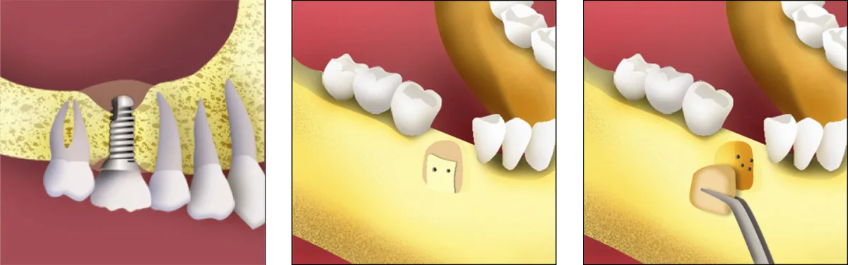 Maxillary sinus lift procedure showing elevated Schneiderian membrane and graft placement