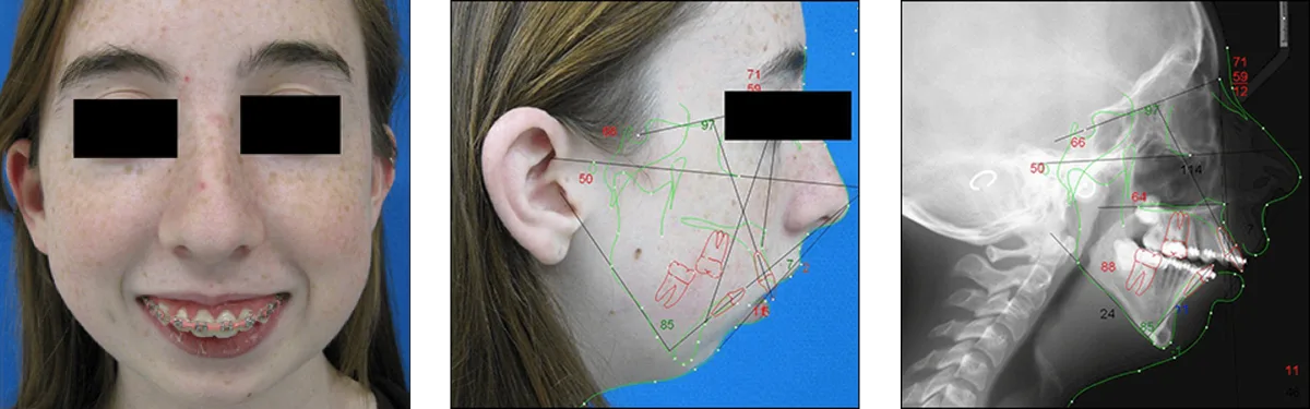 Orthognathic surgical planning model demonstrating maxillary and mandibular realignment