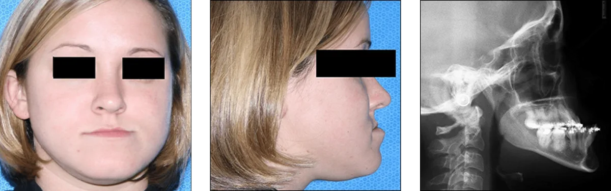 Surgical osteotomy demonstration showing Le Fort I and bilateral sagittal split repositioning