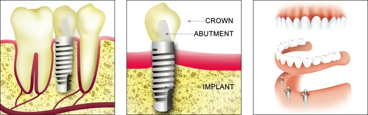 Anatomical structure of a dental implant including titanium post, custom abutment, and ceramic crown