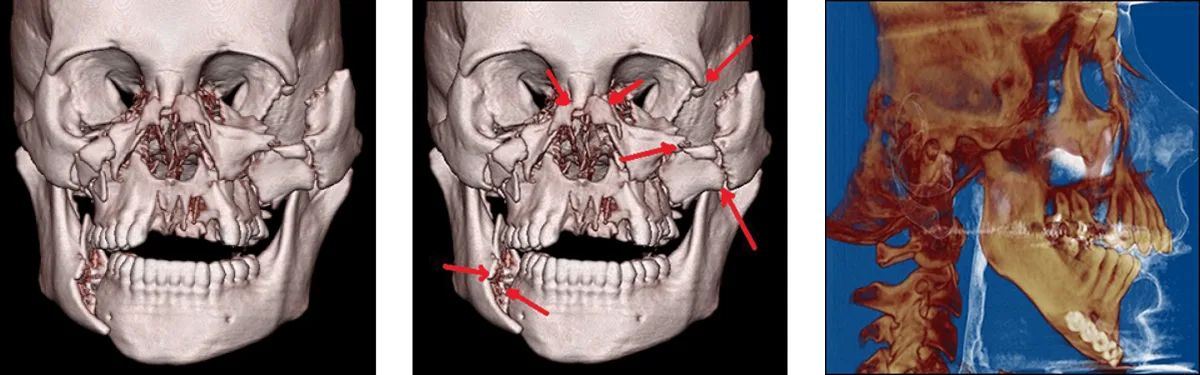 3D computed tomography reconstruction demonstrating complex maxillofacial and mandibular fractures