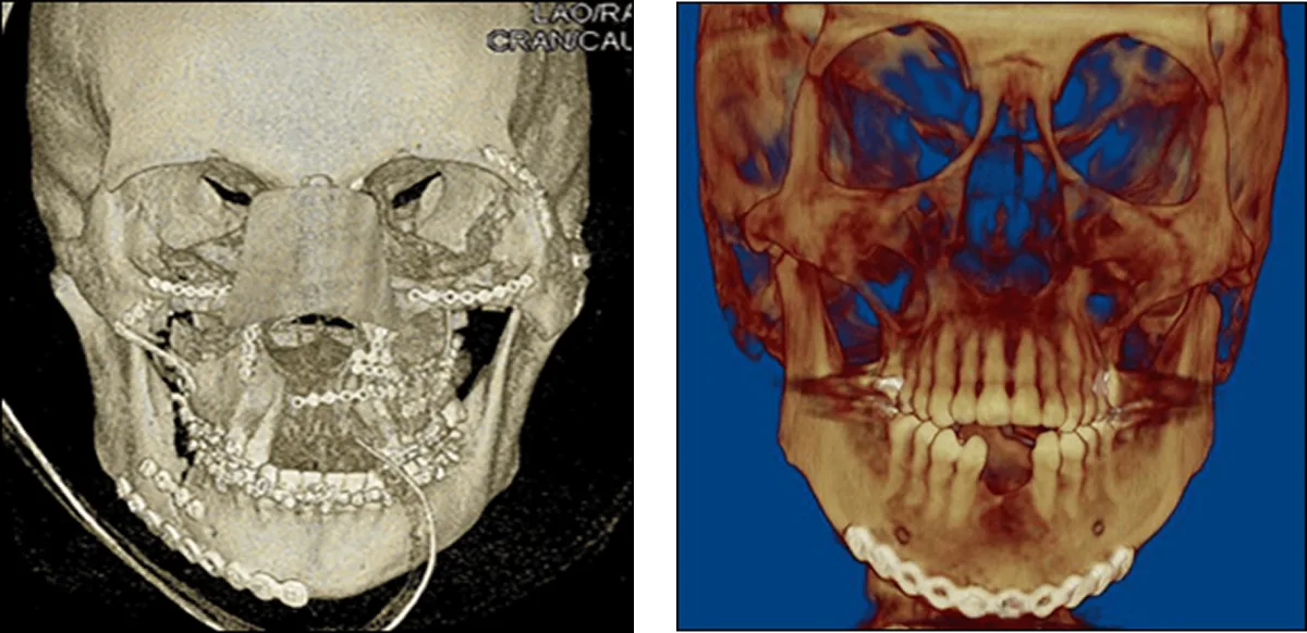 Surgical fixation of facial fractures showing anatomical alignment and low-profile titanium plates