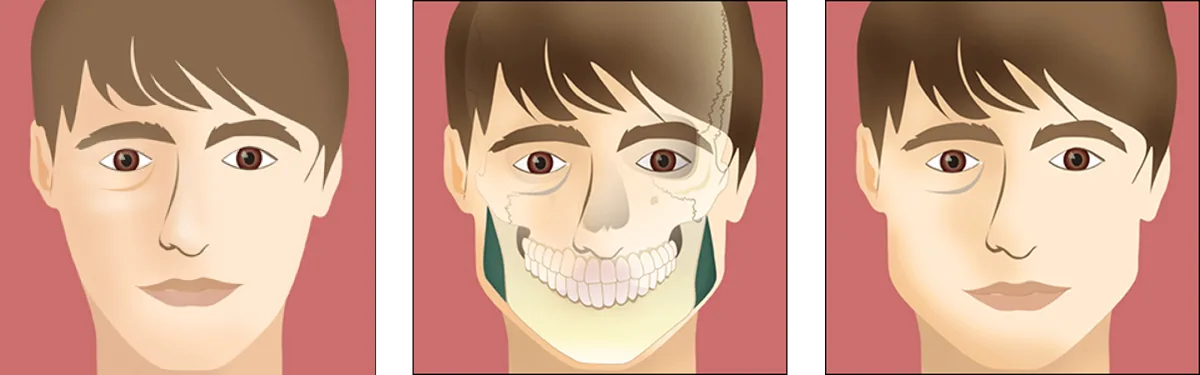 Facial implants anatomical diagram demonstrating malar cheek and mandibular angle placement
