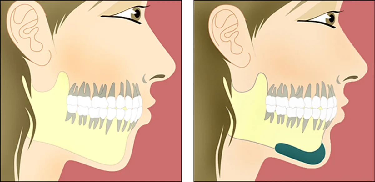 Three-dimensional post-operative projection of cheek and jawline implants