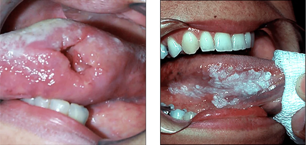 Clinical examination of the oral mucosa identifying localized tissue changes and lesions