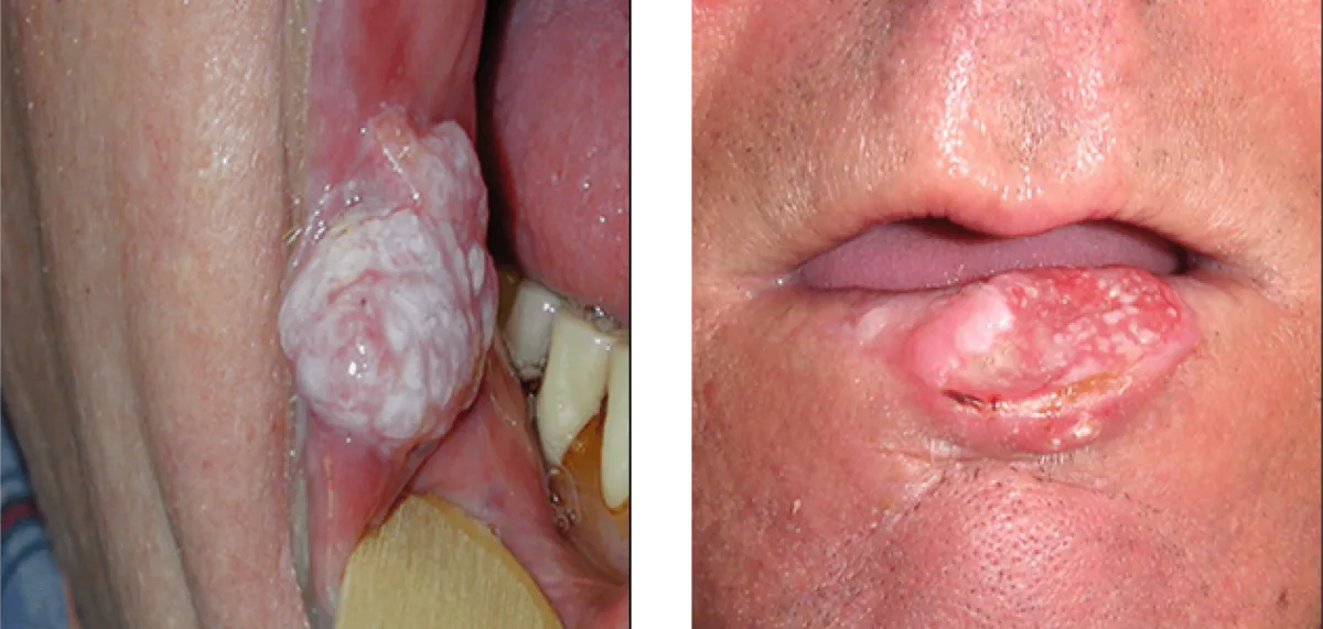 Diagnostic oral pathology tissue sampling and histological evaluation setup