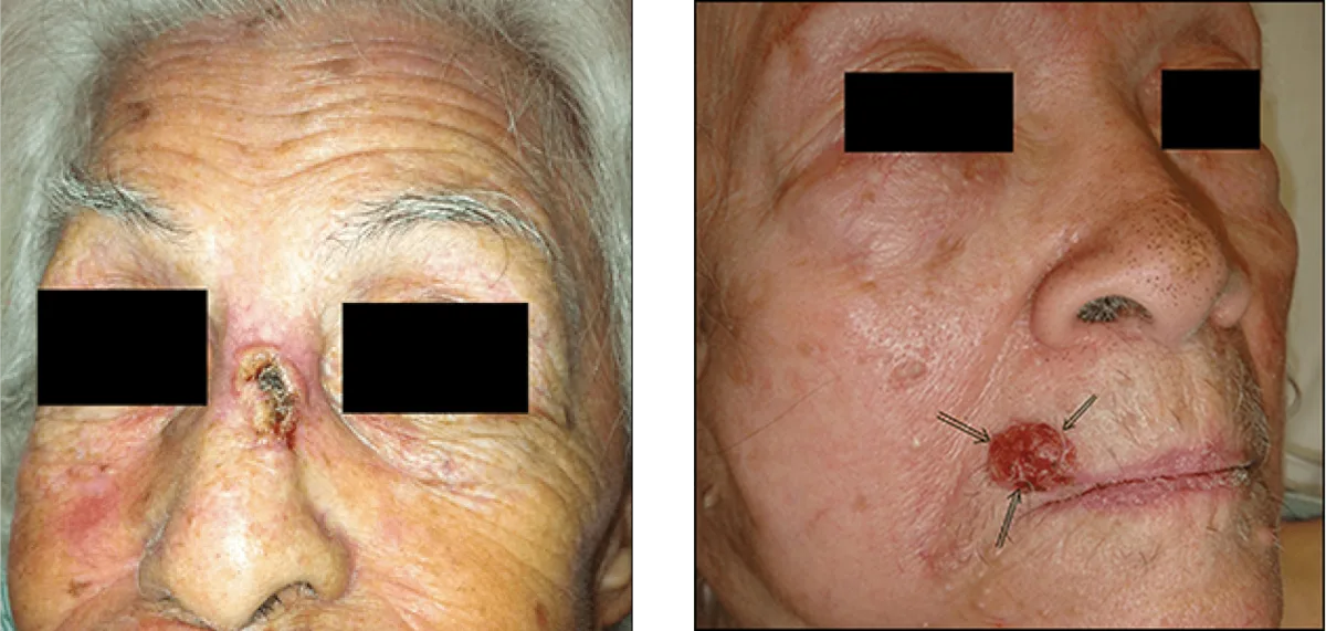 Surgical elliptical excision and layered closure for facial skin lesion removal