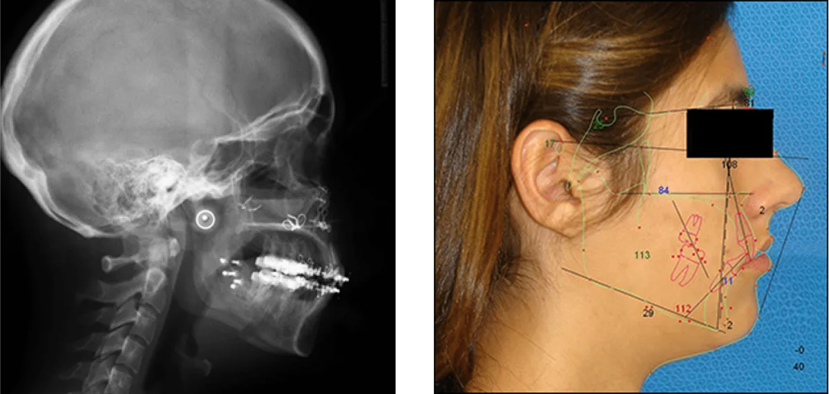 Sleep apnea 3D airway scan showing pharyngeal constriction before corrective surgery