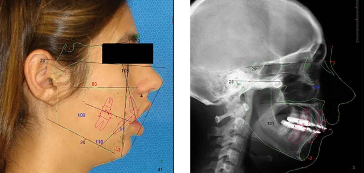 Post-surgical airway expansion following maxillomandibular advancement